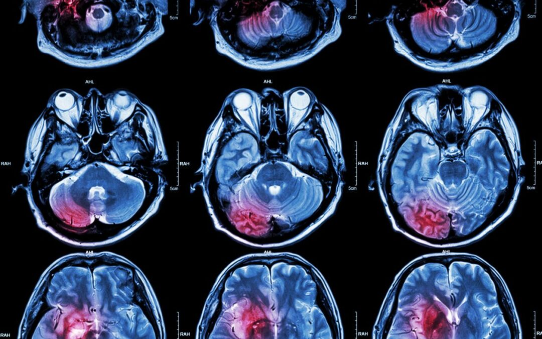 Journal Club 1: Epidiolex in Epilepsy